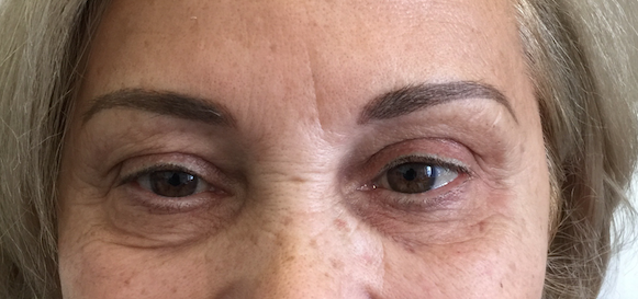 after-treatment