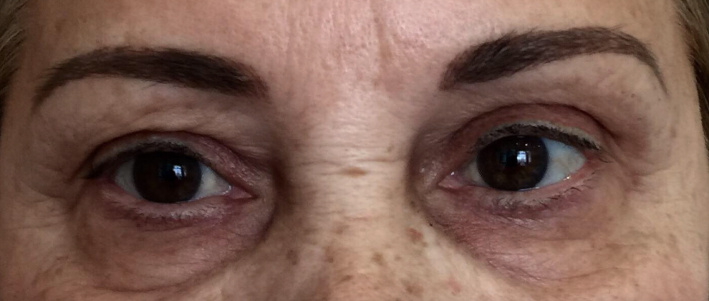 BEFORE TREATMENT